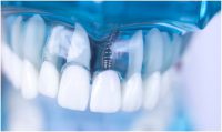 dental-implants