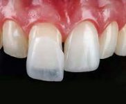 veneers
