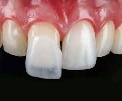 veneers