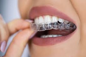 clear-aligners