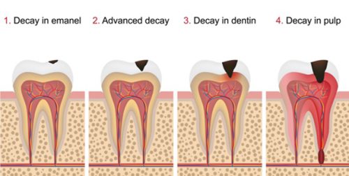 decay