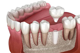 zirconia-dental-implants